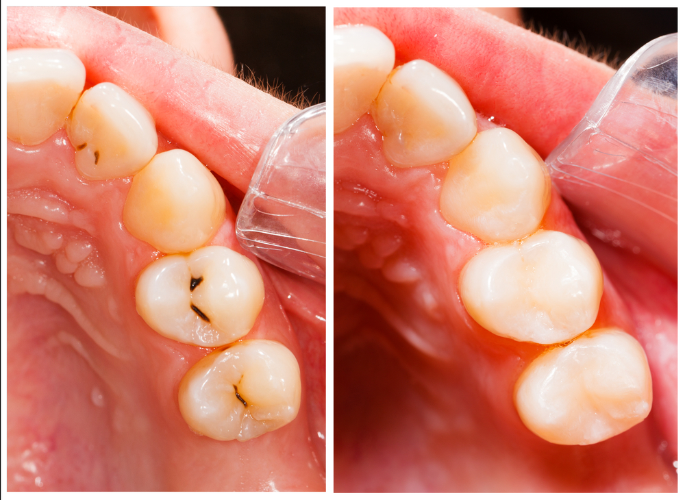 Composite Fillings - Tooth-Colored Fillings